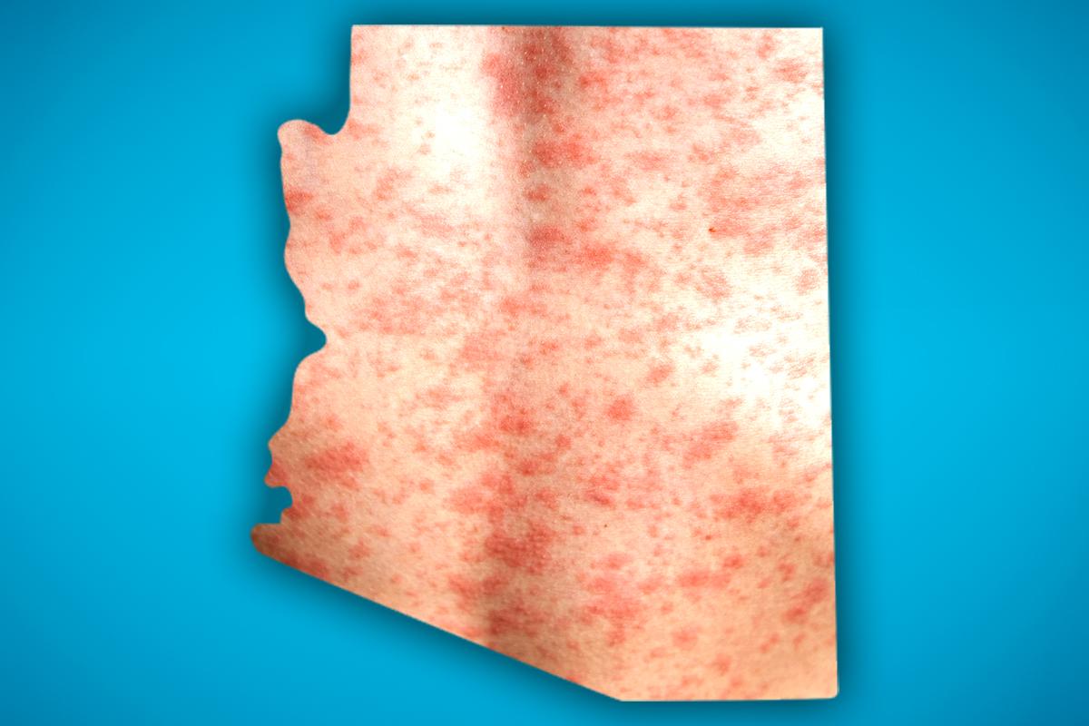 a map of Arizona is covered with splotchy, rashy skin, evocative of measles