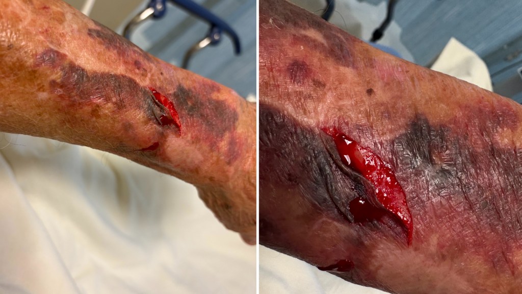 lacerated arms