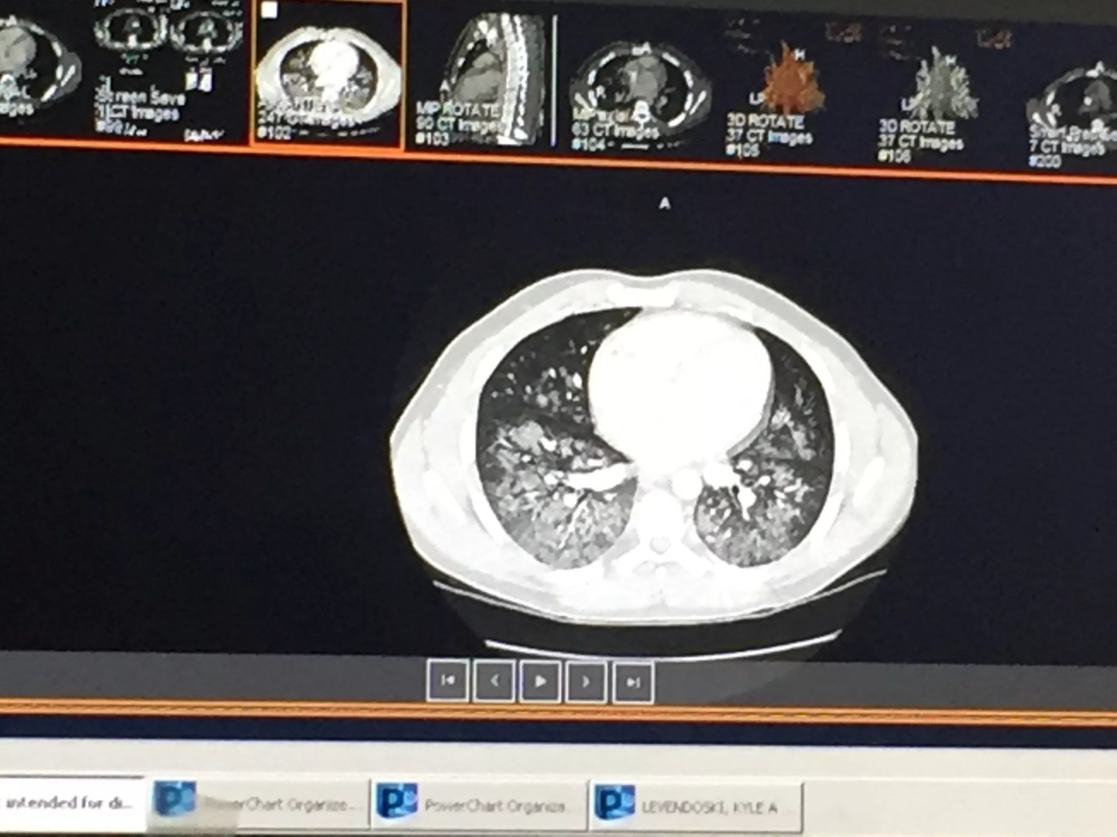 ‘It Just Destroyed Me’: Phoenix Man Hospitalized in Suspected Vaping Illness Case