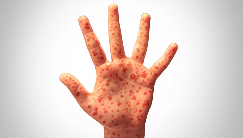 a hand covered in measles marks