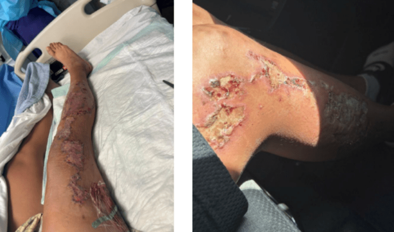 A person's leg is blistered and raw, lying against hospital bedding.